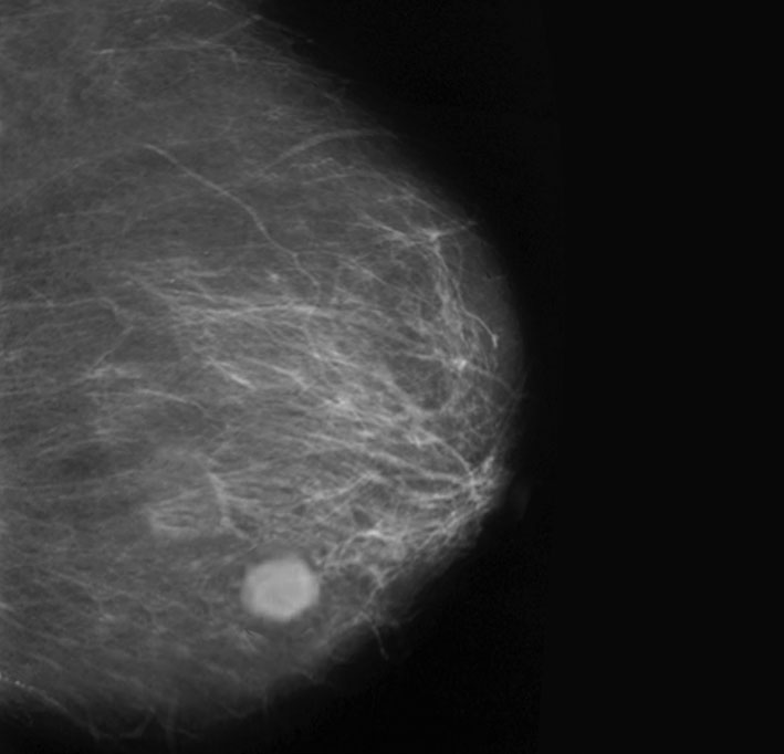 Nude gallery - Do mammograms prevent breast cancer cancer Do mammograms prevent breast